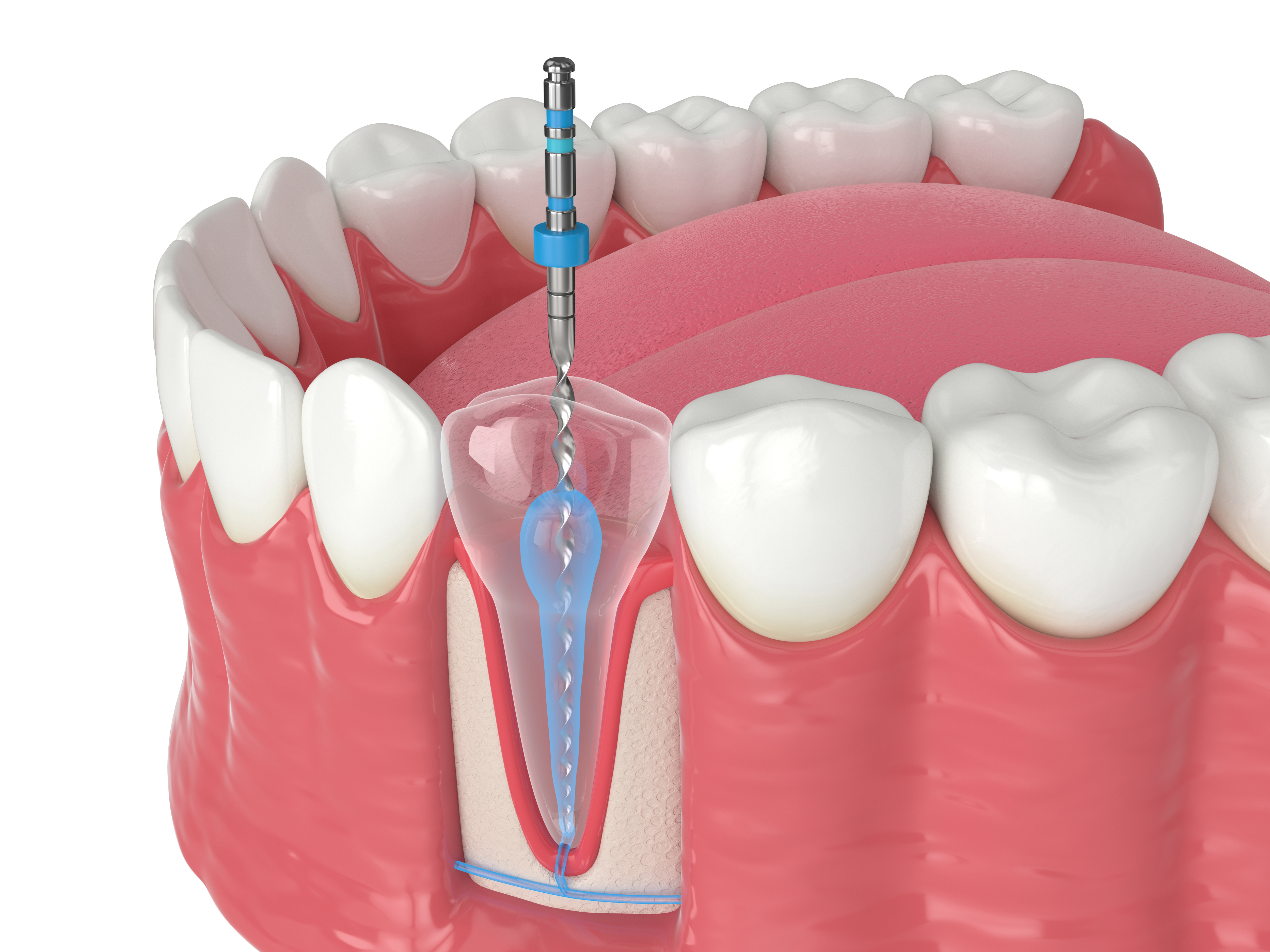 How to Tell If You Need a Root Canal in Chagrin Falls OH
