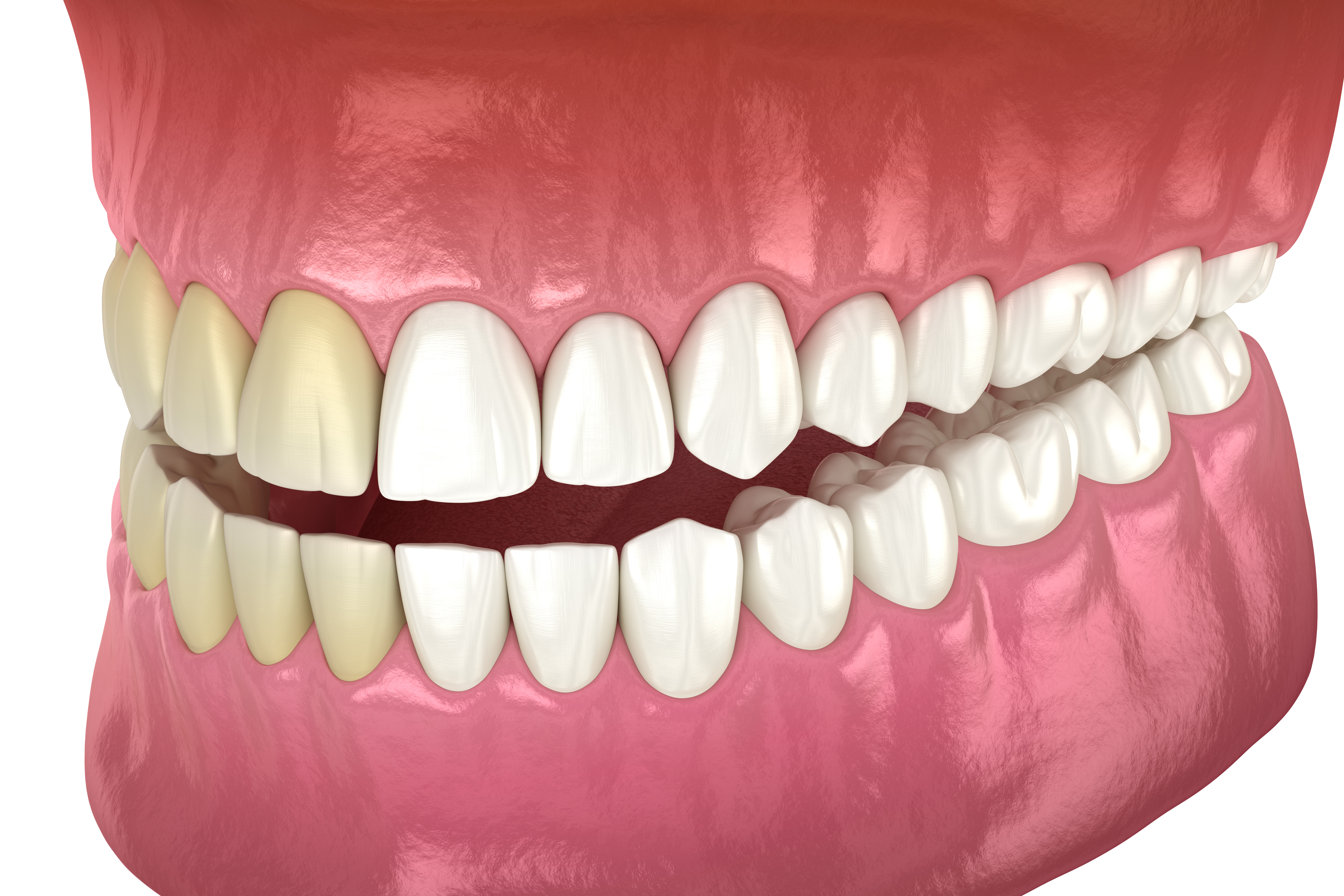 Is Now The Right Time For Teeth Whitening? (quiz)