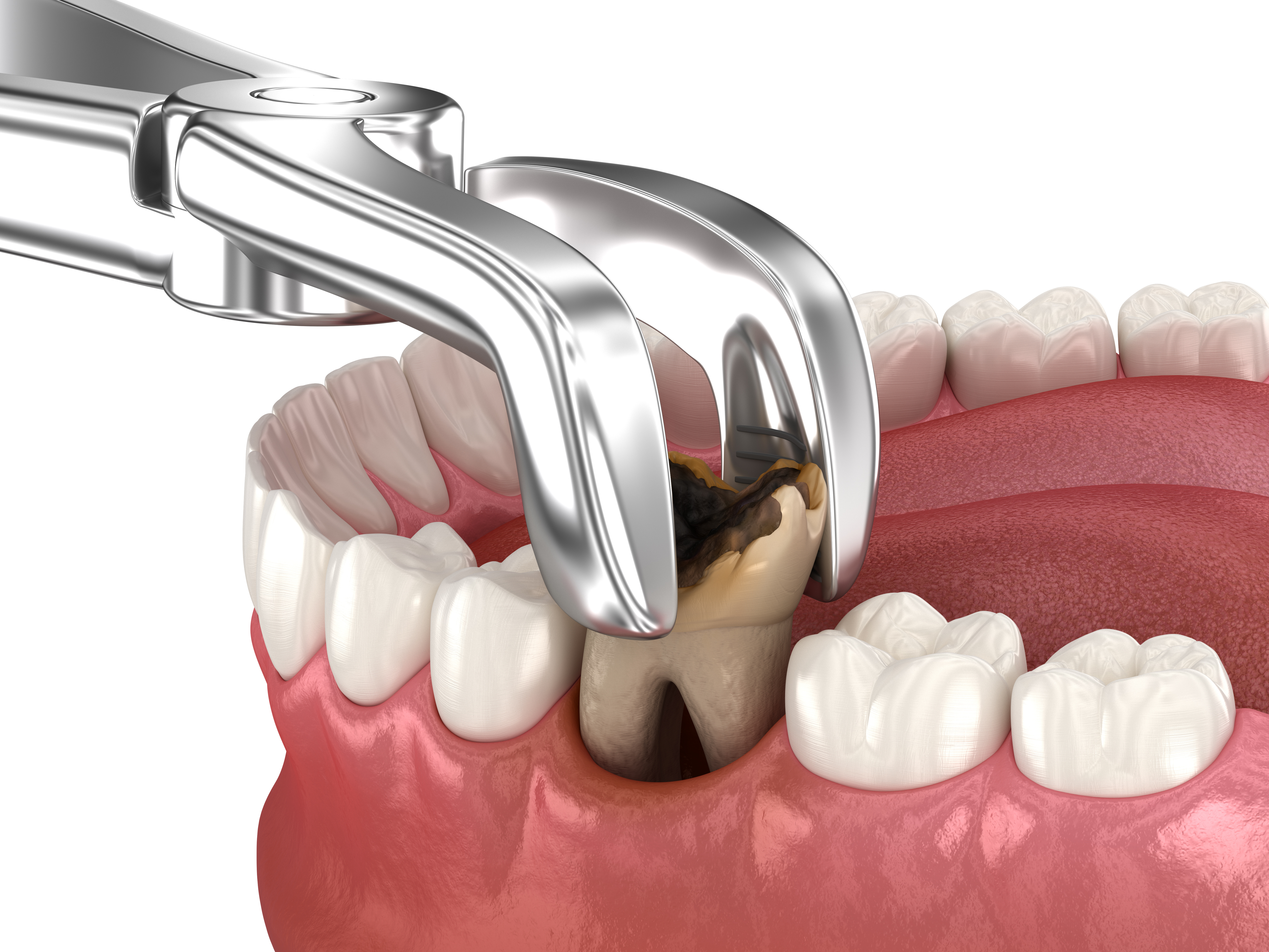 How To Handle An Emergency Tooth Extraction Over The Holidays